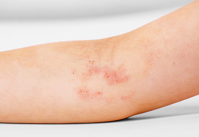 アトピー性皮膚炎