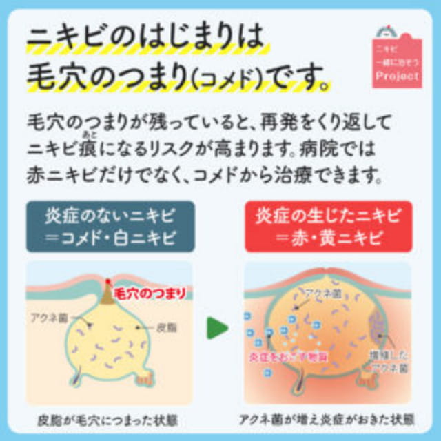 にきびについて