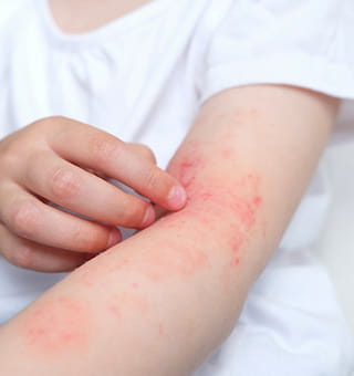 かゆくてつらいアトピー性皮膚炎には光線治療がおすすめです。