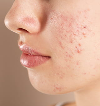 そのニキビ保険診療で治るかもしれません。ぜひ一度当院にご相談を。