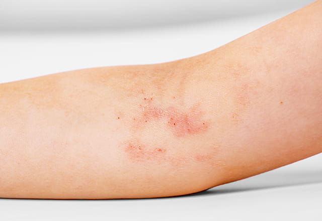 アトピー性皮膚炎について