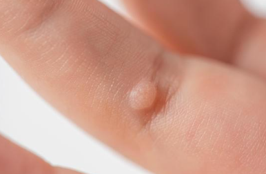 尋常性疣贅（イボ）について