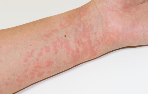 蕁麻疹について
