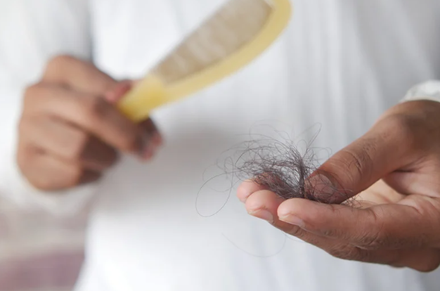 円形脱毛症について