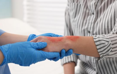 火傷（熱傷）について