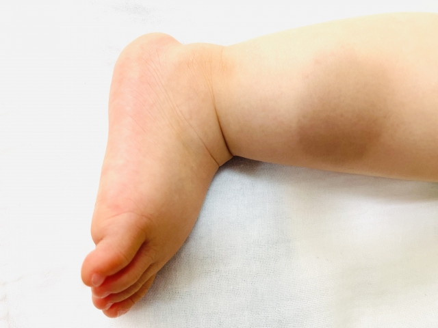 異所性蒙古斑について