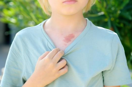 単純性血管腫について